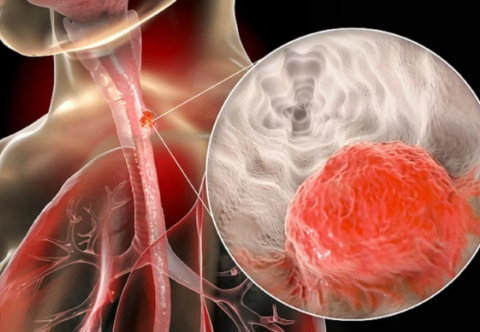 Cách phòng ngừa ung thư thực quản